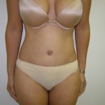 Tummy Tuck Before & After Patient #4065