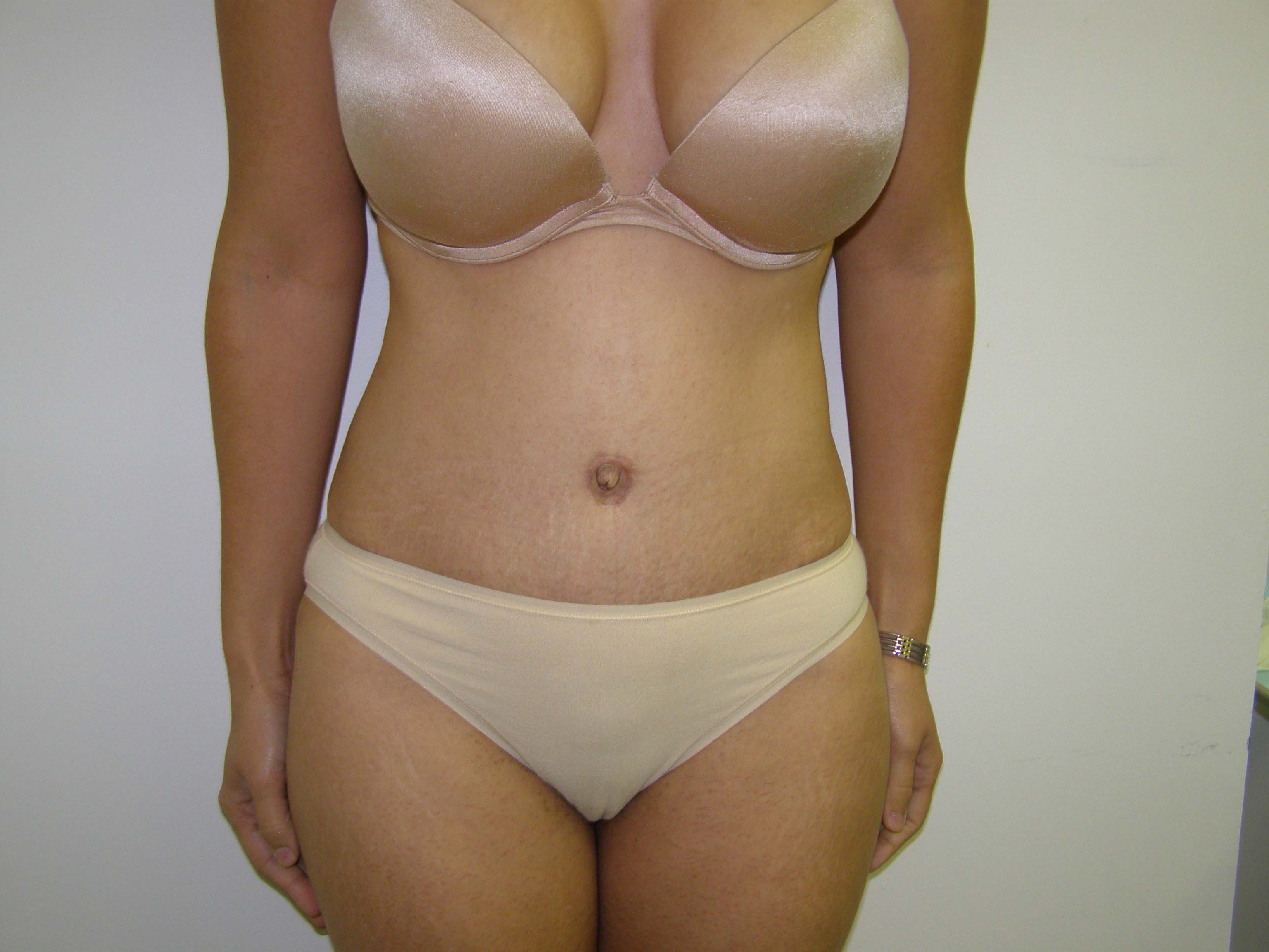 Tummy Tuck Before & After Patient #4065