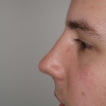 Rhinoplasty Before & After Patient #4195