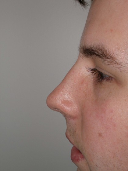 Rhinoplasty Before & After Patient #4195