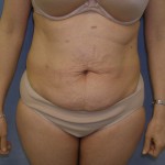 Tummy Tuck Before & After Patient #4069