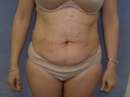 Tummy Tuck Before & After Patient #4069