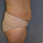 Tummy Tuck Before & After Patient #4069