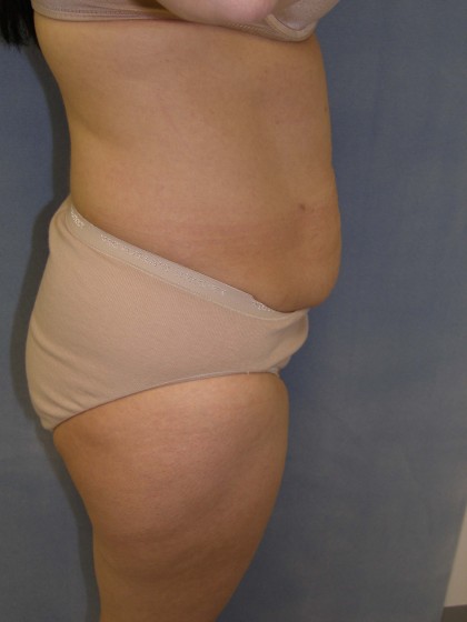 Tummy Tuck Before & After Patient #4069