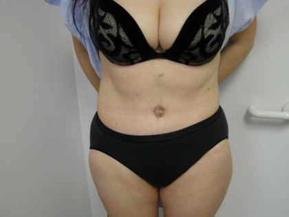 Tummy Tuck Before & After Patient #4069