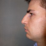 Rhinoplasty Before & After Patient #4227