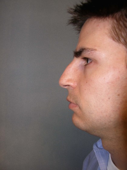 Rhinoplasty Before & After Patient #4227