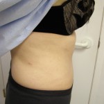Tummy Tuck Before & After Patient #4069