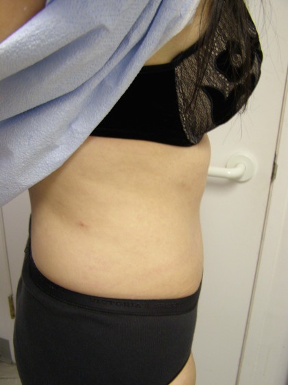 Tummy Tuck Before & After Patient #4069