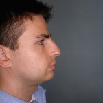 Rhinoplasty Before & After Patient #4227