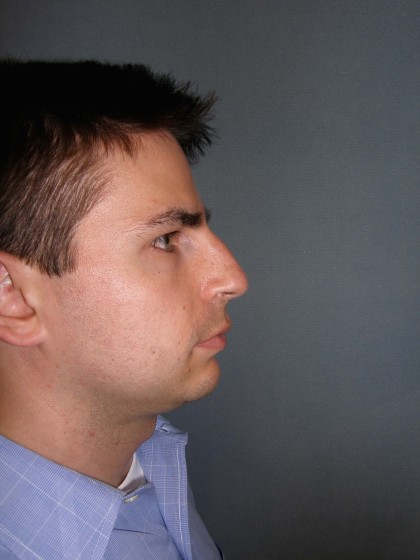Rhinoplasty Before & After Patient #4227