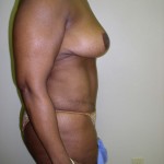 Breast Lift Before & After Patient #4102