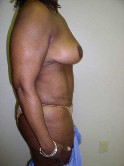 Breast Lift Before & After Patient #4102