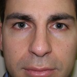 Rhinoplasty Before & After Patient #4227