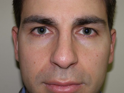 Rhinoplasty Before & After Patient #4227