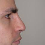 Rhinoplasty Before & After Patient #4227
