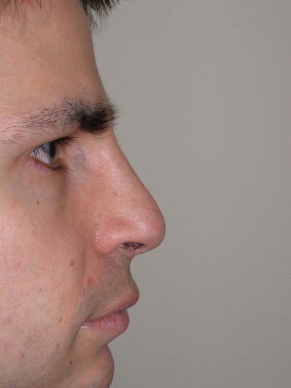 Rhinoplasty Before & After Patient #4227