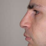 Rhinoplasty Before & After Patient #4227