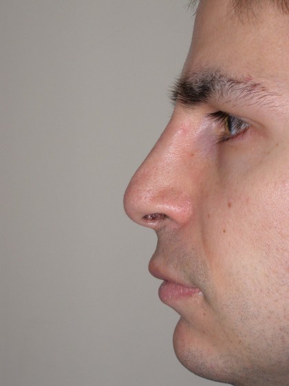 Rhinoplasty Before & After Patient #4227