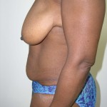 Breast Lift Before & After Patient #4102