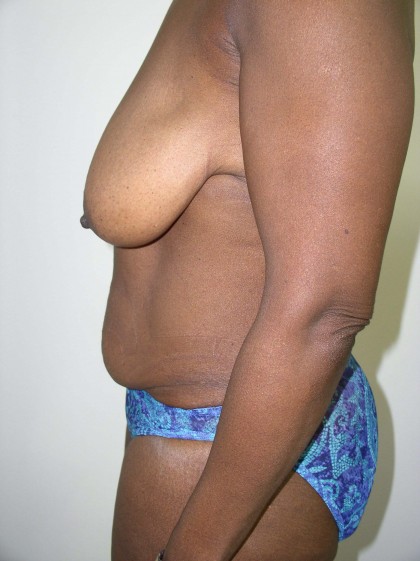 Breast Lift Before & After Patient #4102