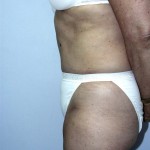 Tummy Tuck Before & After Patient #4112