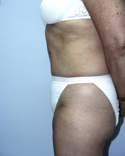 Tummy Tuck Before & After Patient #4112