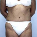 Tummy Tuck Before & After Patient #4112