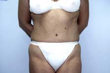 Tummy Tuck Before & After Patient #4112