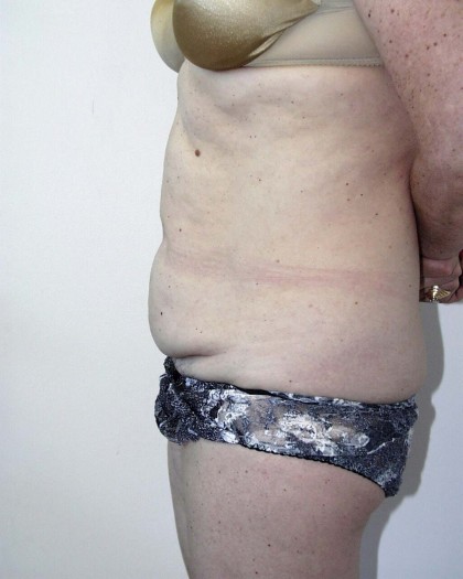 Tummy Tuck Before & After Patient #4112