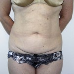 Tummy Tuck Before & After Patient #4112