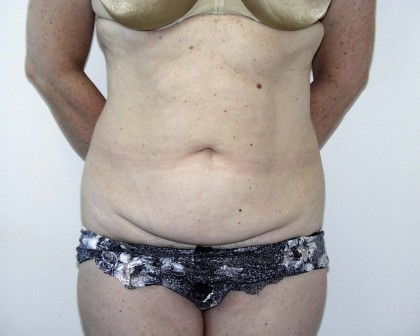 Tummy Tuck Before & After Patient #4112