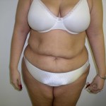 Tummy Tuck Before & After Patient #4117