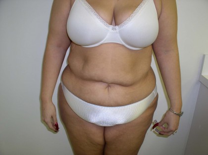 Tummy Tuck Before & After Patient #4117