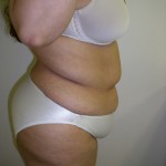 Tummy Tuck Before & After Patient #4117