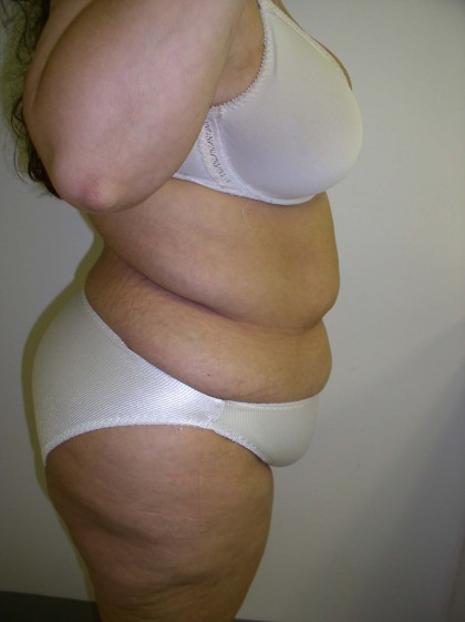Tummy Tuck Before & After Patient #4117