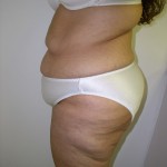 Tummy Tuck Before & After Patient #4117