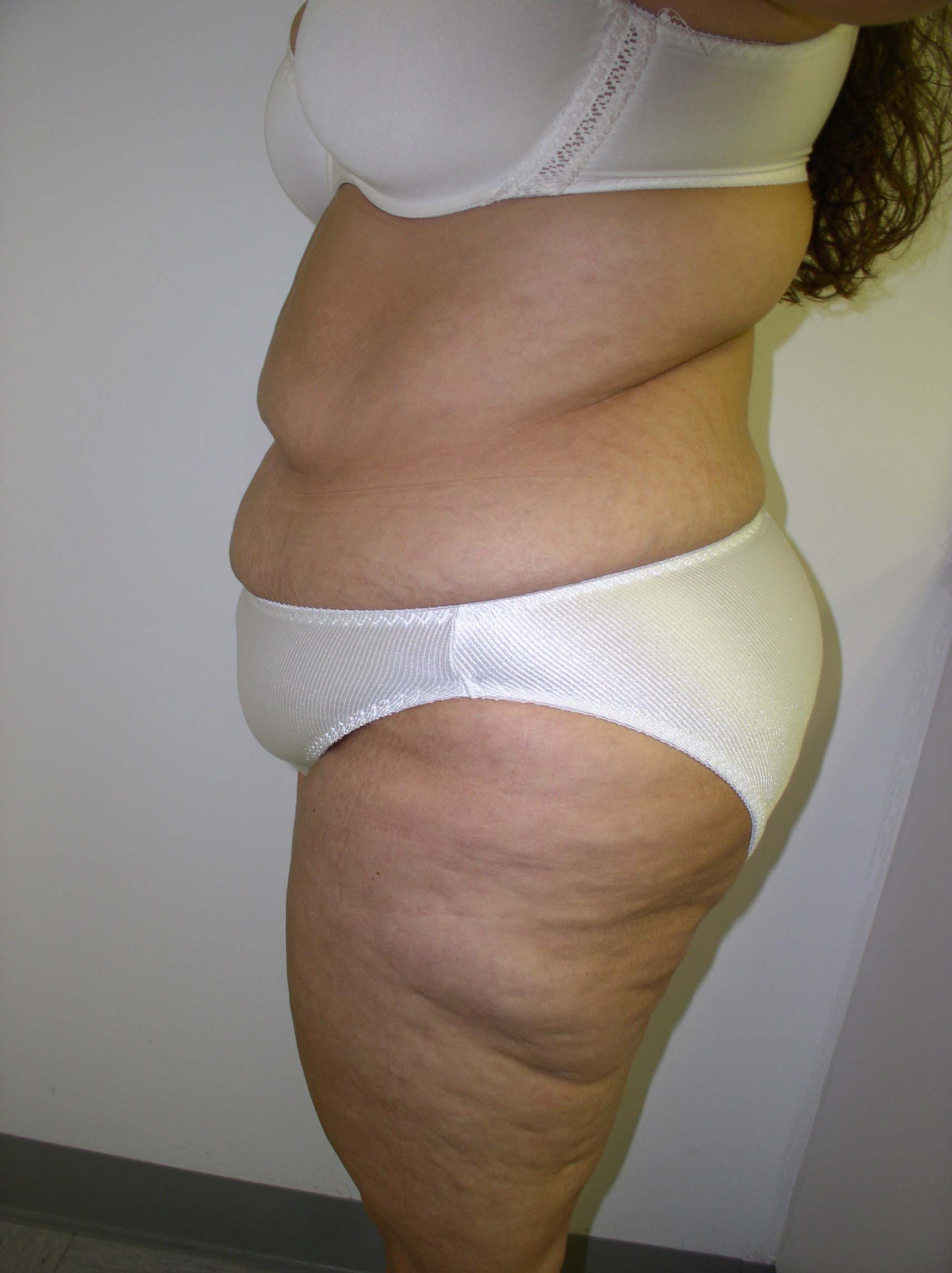 Tummy Tuck Before & After Patient #4117