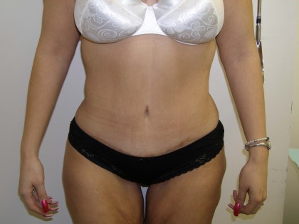 Tummy Tuck Before & After Patient #4117