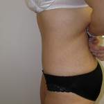 Tummy Tuck Before & After Patient #4117