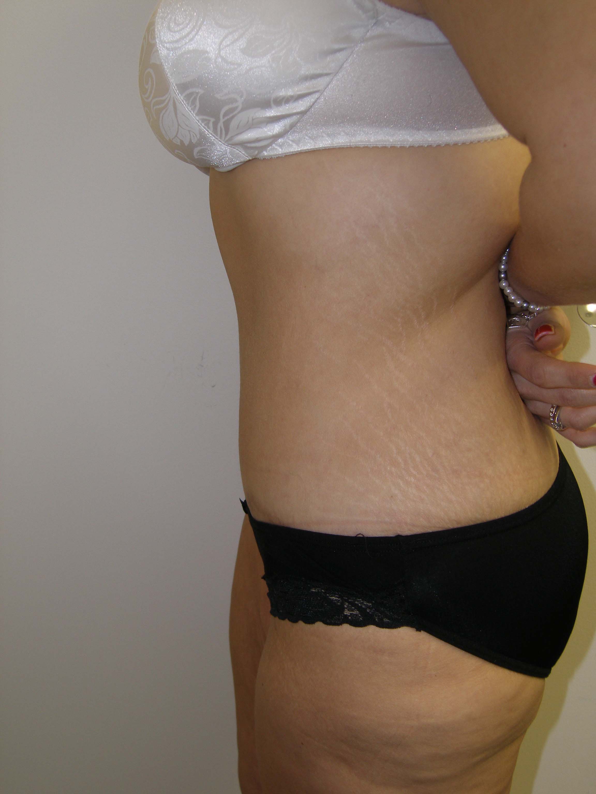 Tummy Tuck Before & After Patient #4117