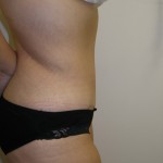 Tummy Tuck Before & After Patient #4117
