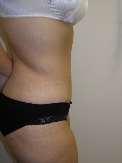Tummy Tuck Before & After Patient #4117