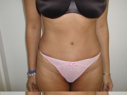 Tummy Tuck Before & After Patient #4125