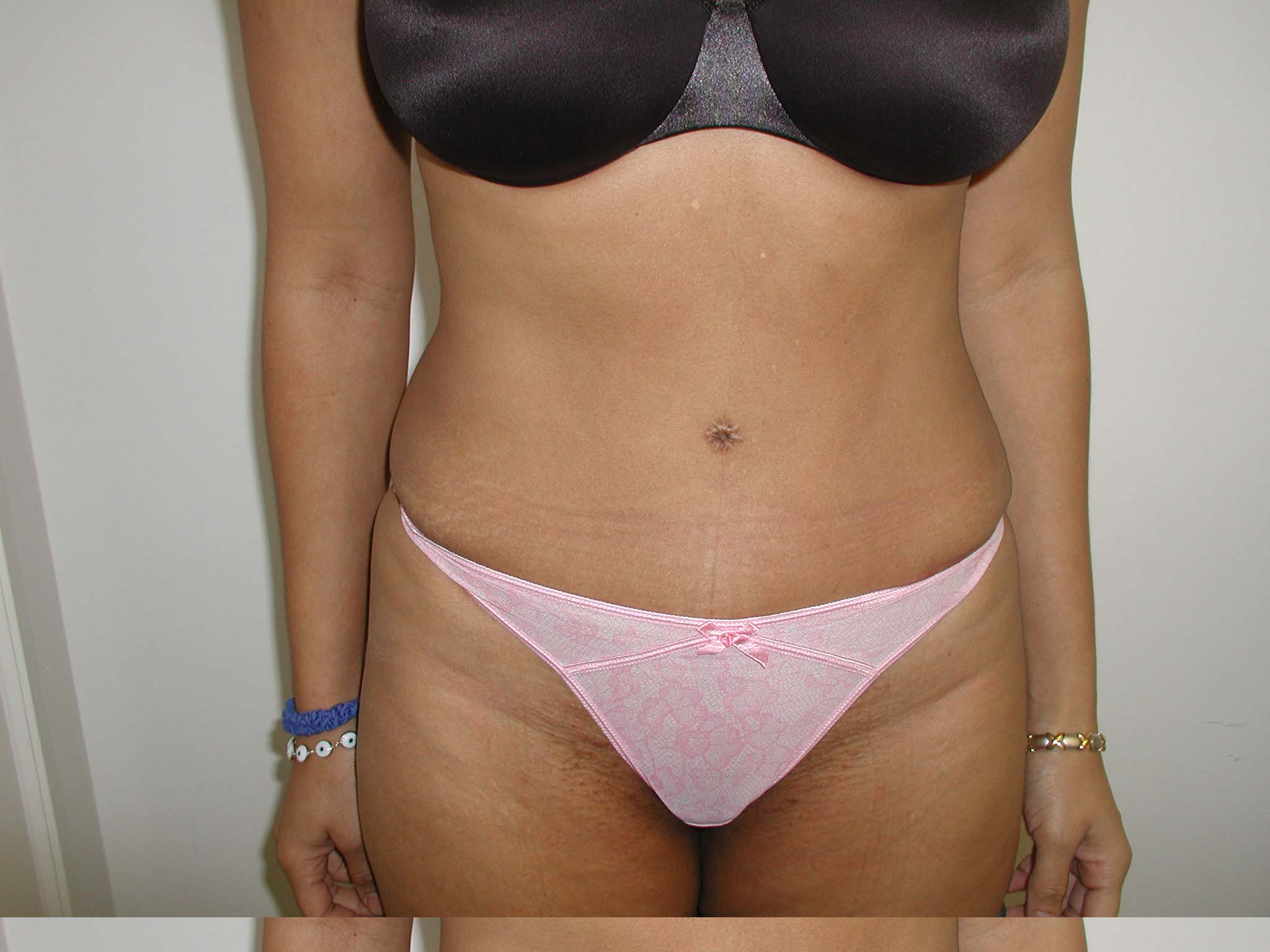 Tummy Tuck Before & After Patient #4125
