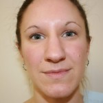 Rhinoplasty Before & After Patient #3994