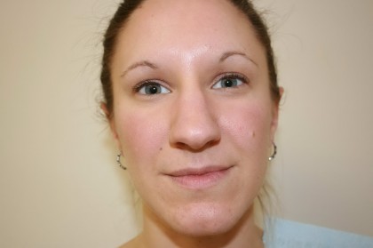 Rhinoplasty Before & After Patient #3994