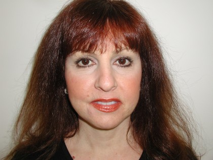 Facelift Before & After Patient #4991