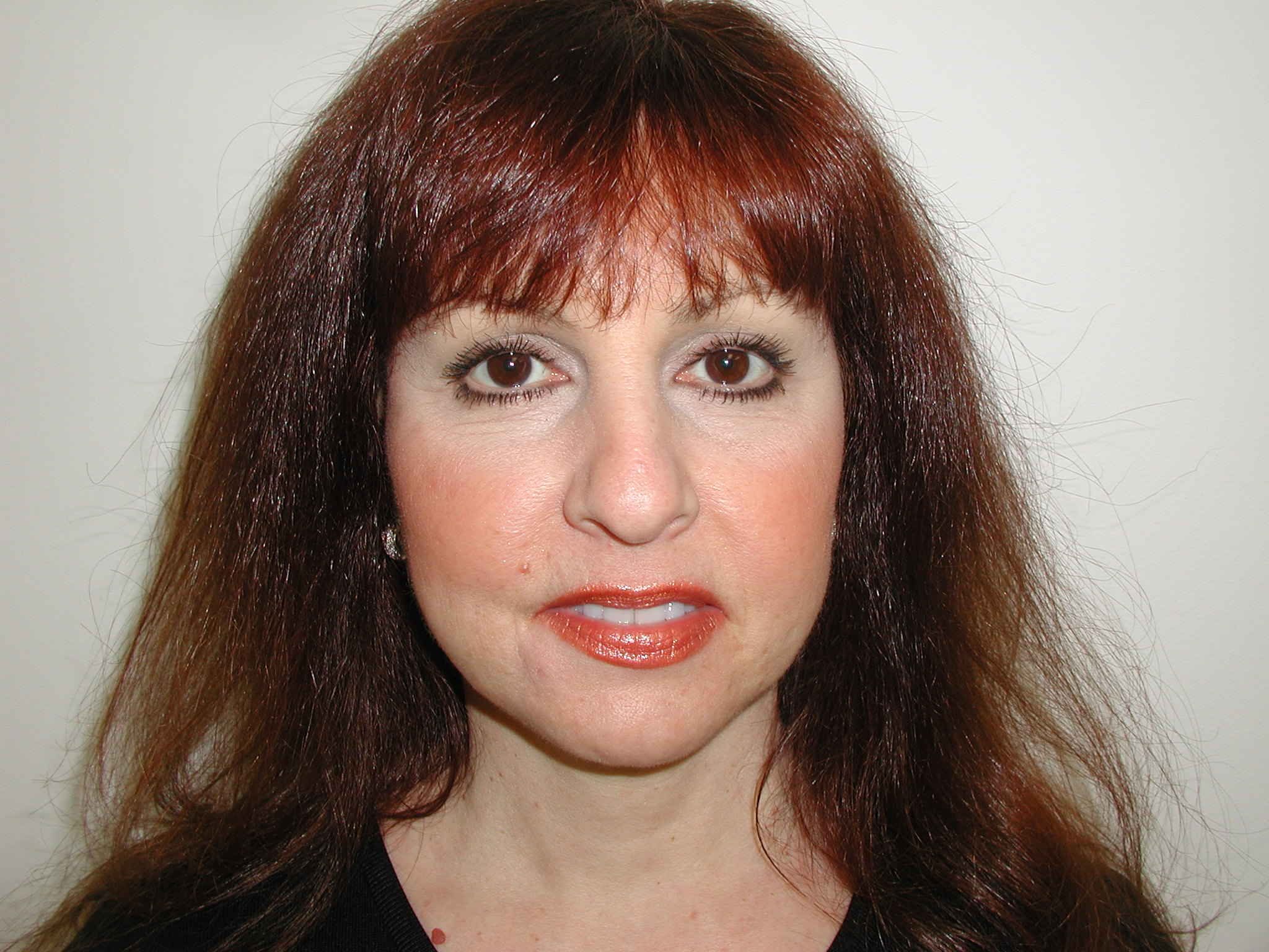 Facelift Before & After Patient #4991