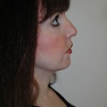 Facelift Before & After Patient #4991